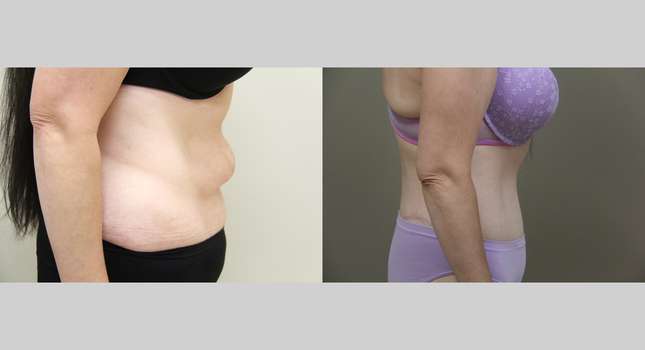 Body Lift: Image #1176