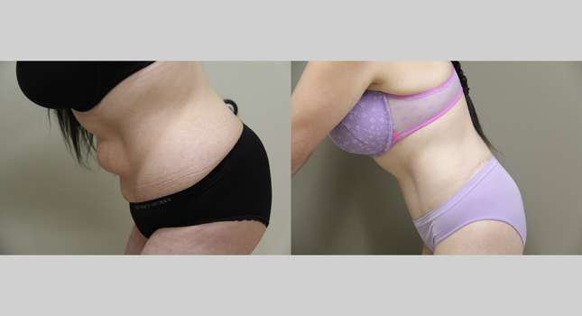 Body Lift: Image #1178