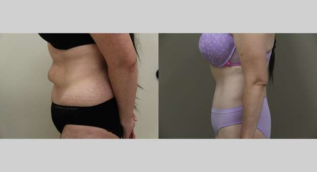 Body Lift: Image #1179