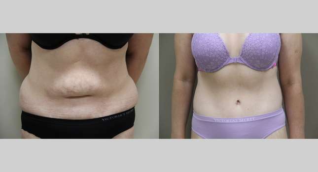 Body Lift: Image #1181
