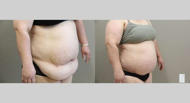 Mommy Makeover: Image #1183