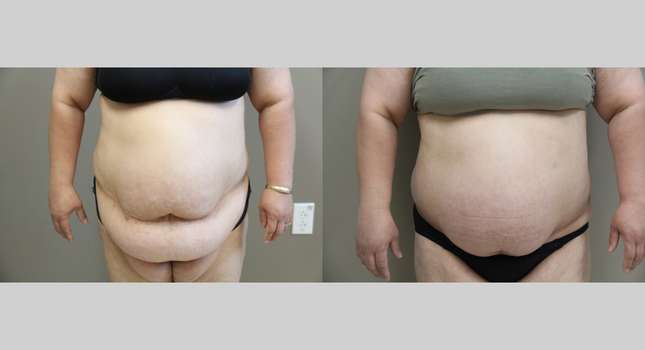 Mommy Makeover: Image #1186