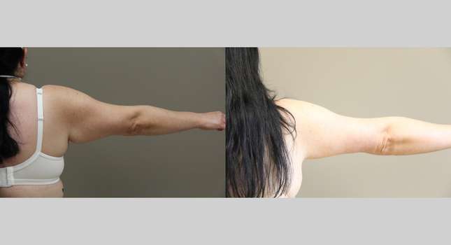 Upper Arm Lift: Image #1187