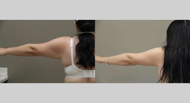 Upper Arm Lift: Image #1188