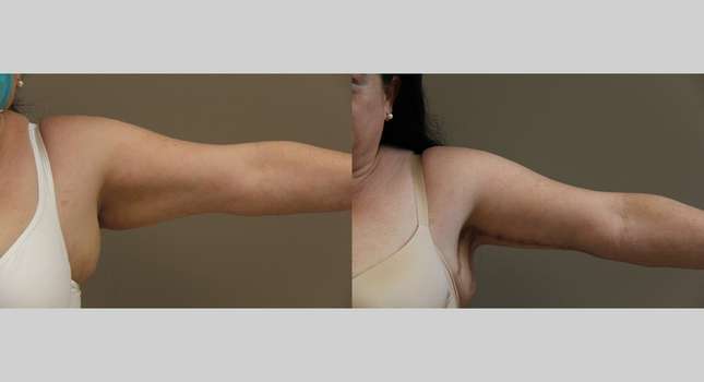 Upper Arm Lift: Image #1189