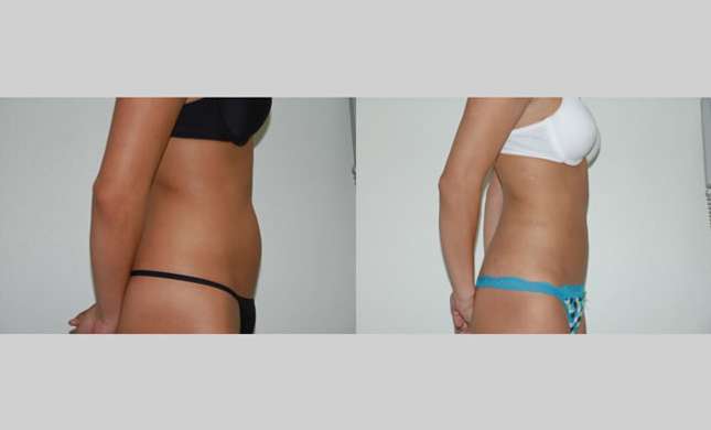 Liposuction: Image #119