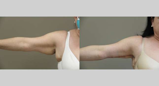 Upper Arm Lift: Image #1190