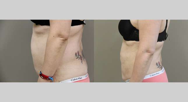 Butock and Thigh Contouring: Image #1191
