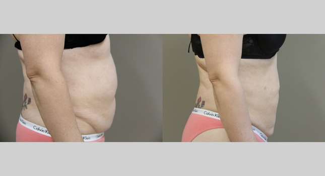 Butock and Thigh Contouring: Image #1192