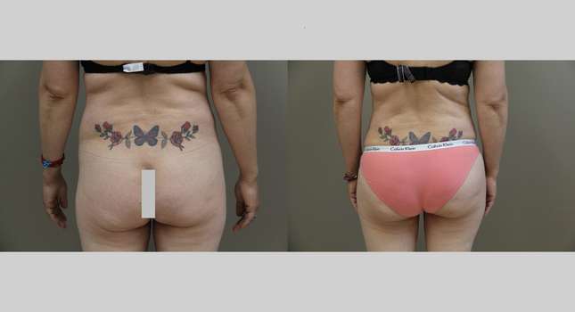 Butock and Thigh Contouring: Image #1193