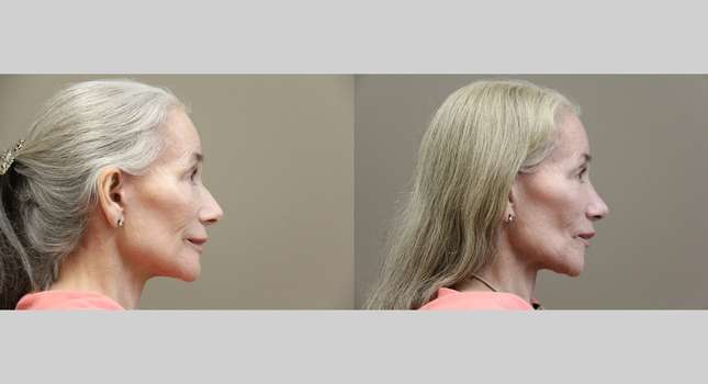 Nose Surgery: Image #1194
