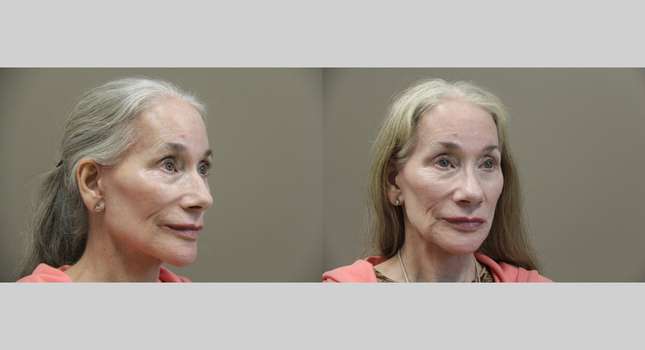 Nose Surgery: Image #1195