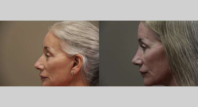 Nose Surgery: Image #1196