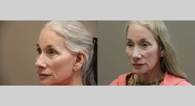 Nose Surgery: Image #1197