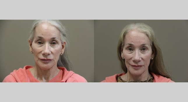 Nose Surgery: Image #1198
