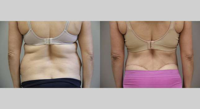 Body Lift: Image #1199
