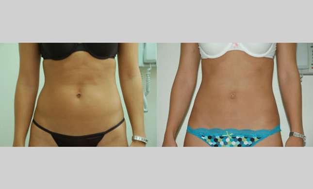 Liposuction: Image #120