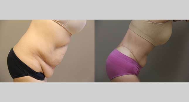 Body Lift: Image #1200