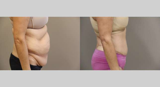 Body Lift: Image #1201