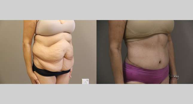 Body Lift: Image #1202