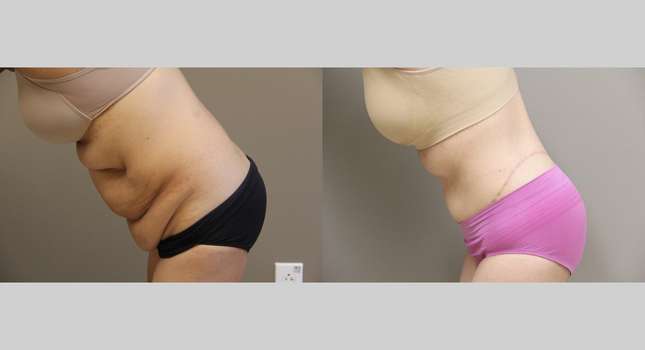 Body Lift: Image #1203