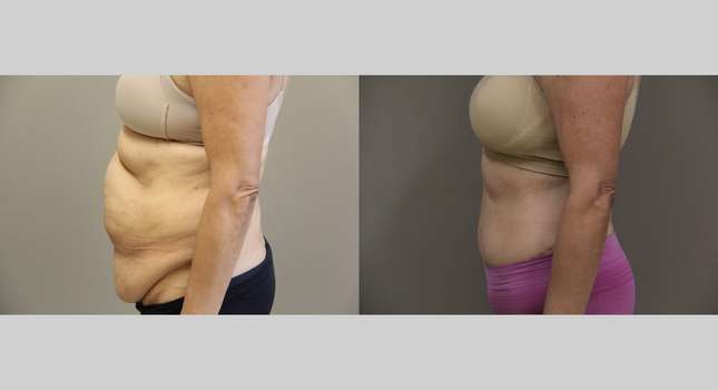 Body Lift: Image #1204