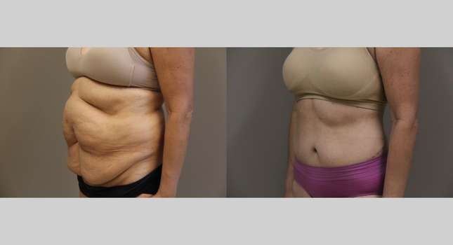 Body Lift: Image #1205