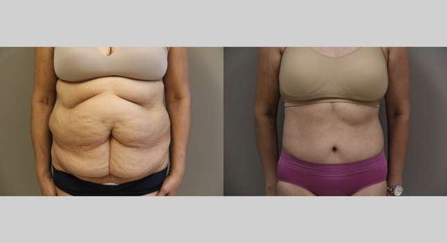 Body Lift: Image #1207