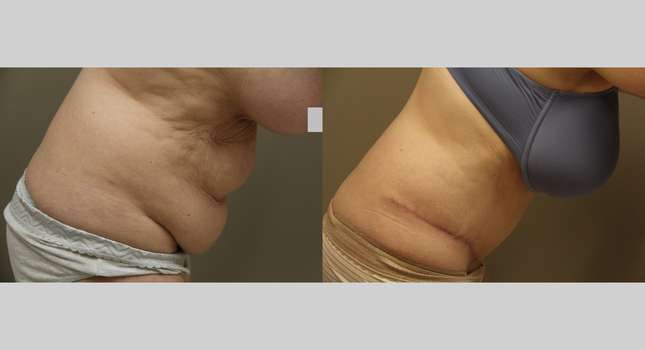 Tummy Tuck: Image #1208