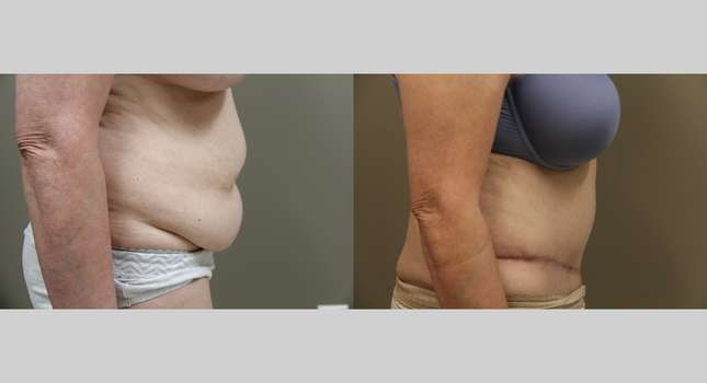 Tummy Tuck: Image #1209