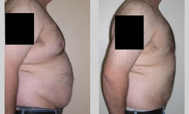 Liposuction: Image #121