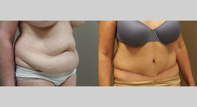 Tummy Tuck: Image #1210