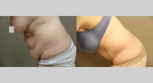 Tummy Tuck: Image #1211