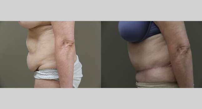 Tummy Tuck: Image #1212