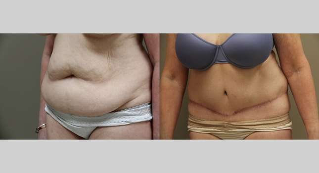 Tummy Tuck: Image #1213