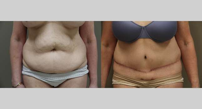 Tummy Tuck: Image #1214