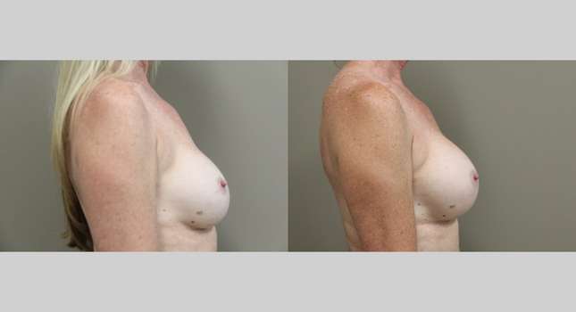 Breast Reconstruction: Image #1220