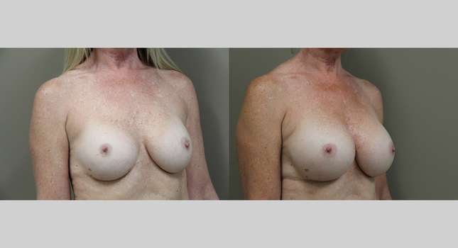 Breast Reconstruction: Image #1221