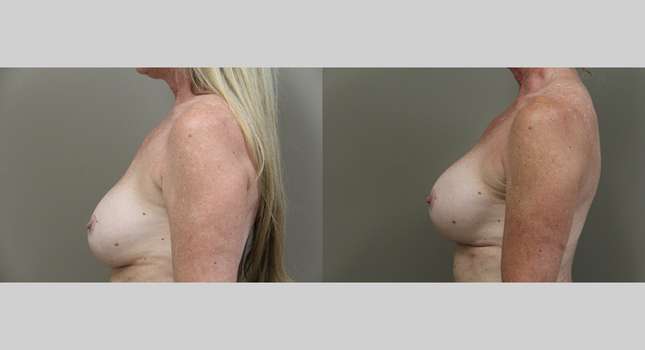 Breast Reconstruction: Image #1222