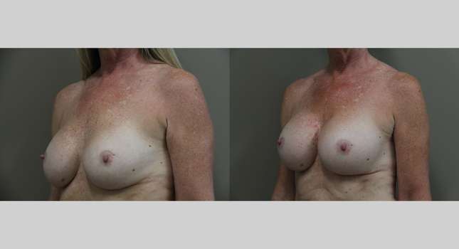 Breast Reconstruction: Image #1223