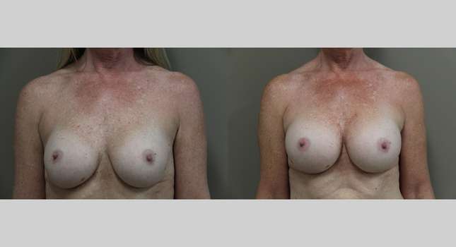 Breast Reconstruction: Image #1224