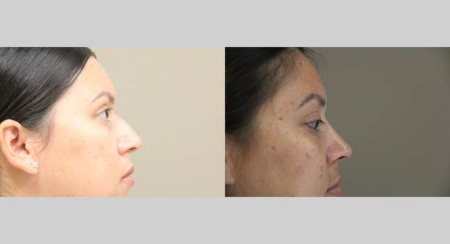 Nose Surgery: Image #1225