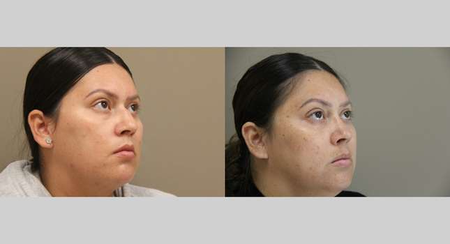 Nose Surgery: Image #1226