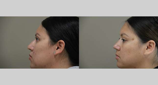 Nose Surgery: Image #1227