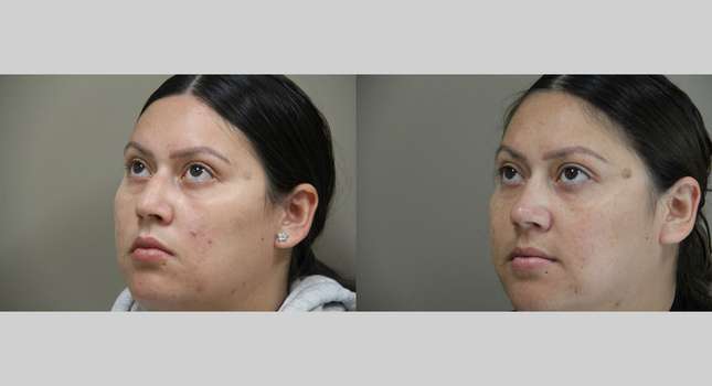 Nose Surgery: Image #1228