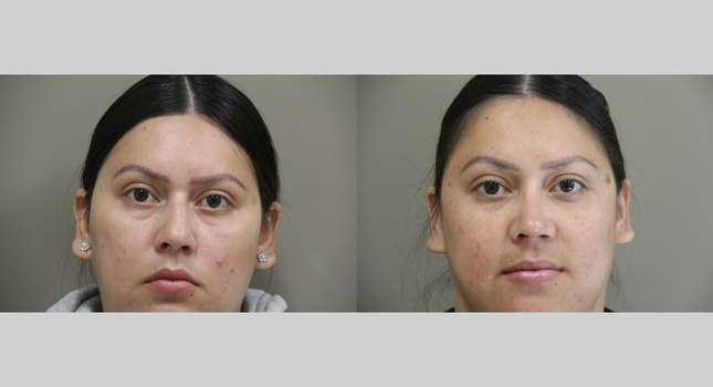 Nose Surgery: Image #1229