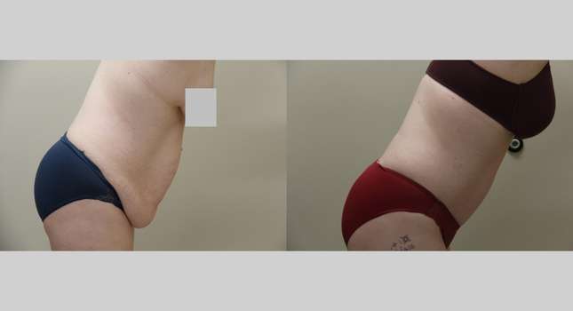 Tummy Tuck: Image #1230