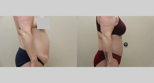 Tummy Tuck: Image #1231