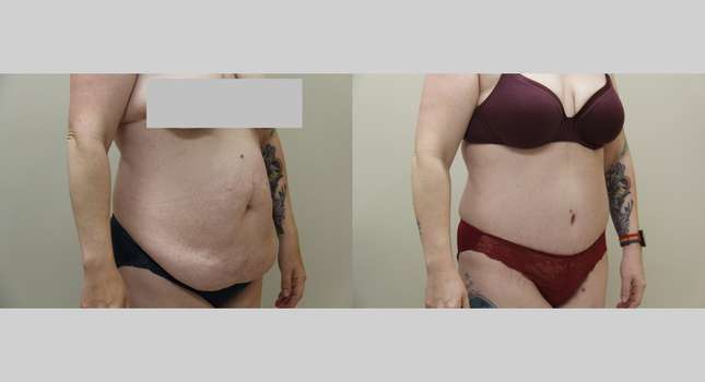 Tummy Tuck: Image #1232