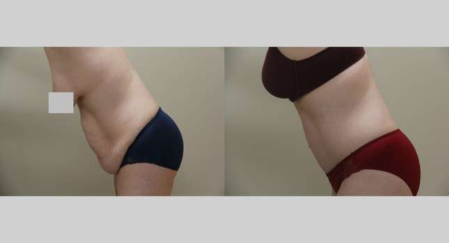 Tummy Tuck: Image #1233